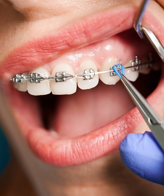 7 Reasons Why You Need Orthodontic Braces