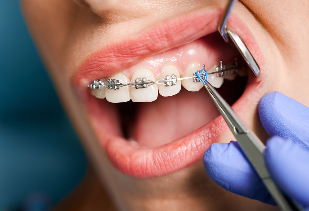 Dental Braces Dubai